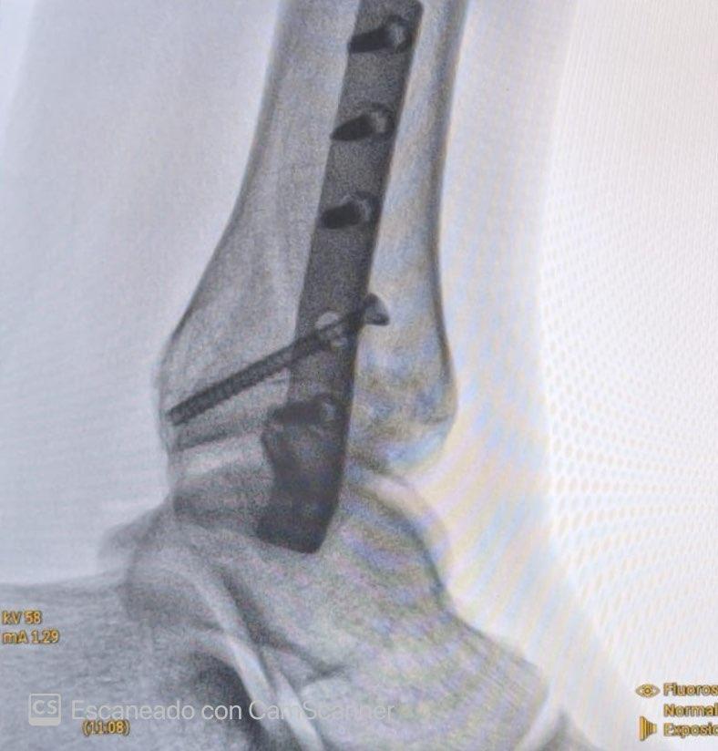 Osteosíntesis de Fractura de Peroné